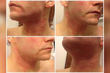 Can Skin Care Products Cause Allergic Reaction