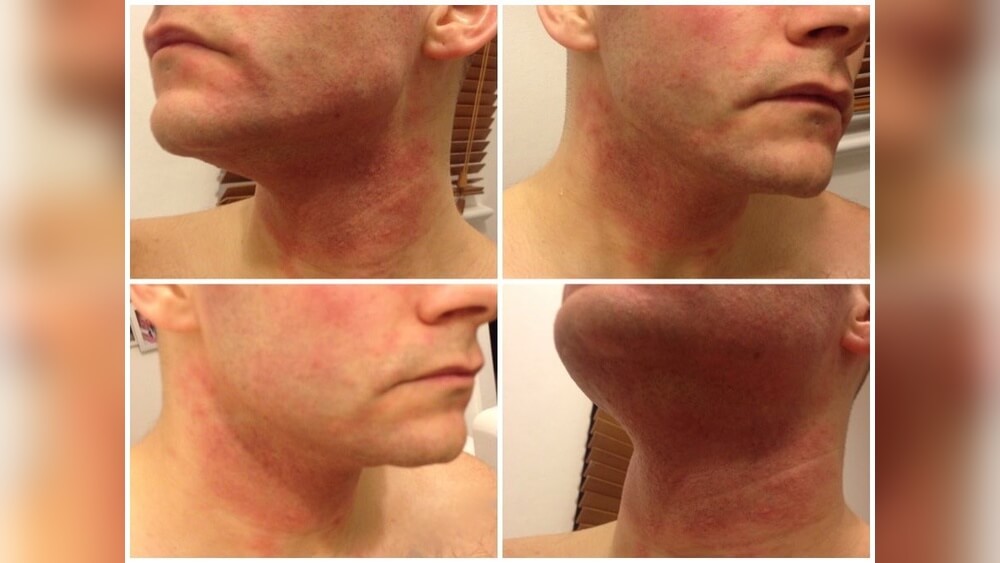 Can Skin Care Products Cause Allergic Reaction? Shocking Truths Revealed 1 Can Skin Care Products Cause Allergic Reaction