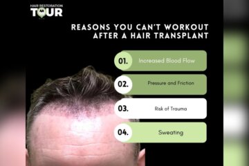 Why CanT I Exercise After Hair Transplant Radiant Glow Health Why CanT I Exercise After Hair Transplant